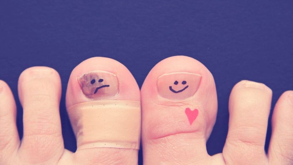 Pourquoi la mycose des ongles est-elle dangereuse 