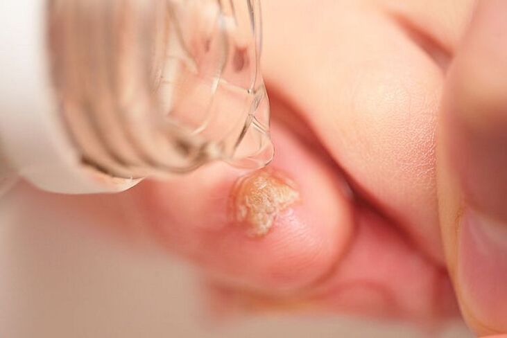 traitement de la mycose des ongles avec du vinaigre