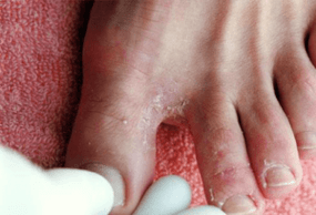 Symptômes de mycose des pieds