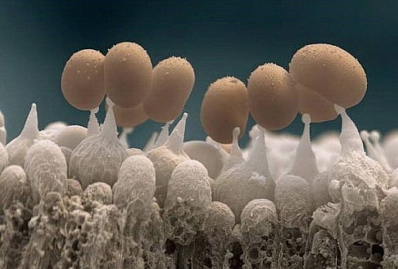 mycose des ongles au microscope