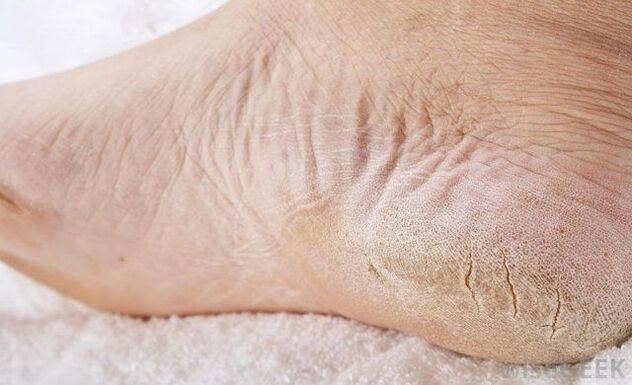 les pieds secs sont un signe de champignon