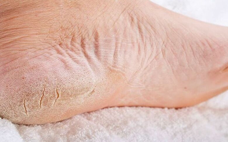 symptômes de champignon du pied