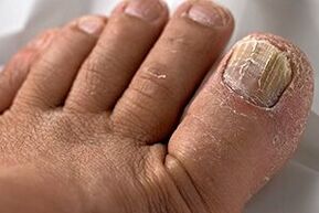 Photo du champignon de l'ongle