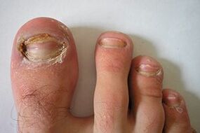 champignon sur les ongles