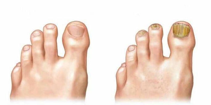 À quoi ressemble le champignon sur les ongles