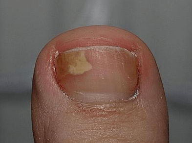 champignon à gauche de l'ongle