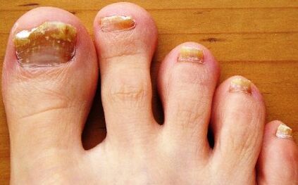 ongles affectés par des champignons