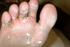 champignon sur les doigts et les pieds