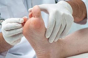 le médecin examine les pieds à la recherche de champignons sur les orteils