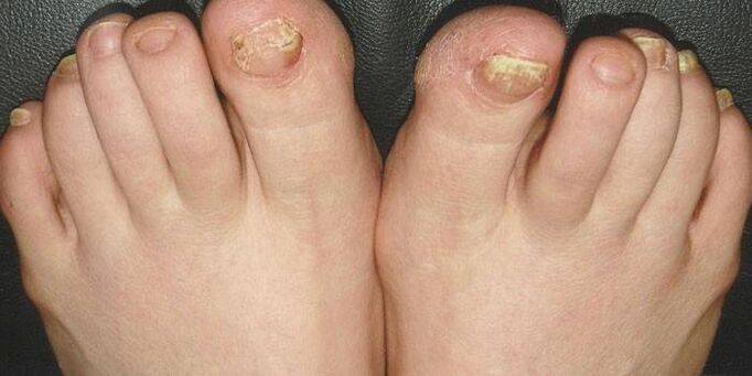 qu'est-ce que la mycose des ongles