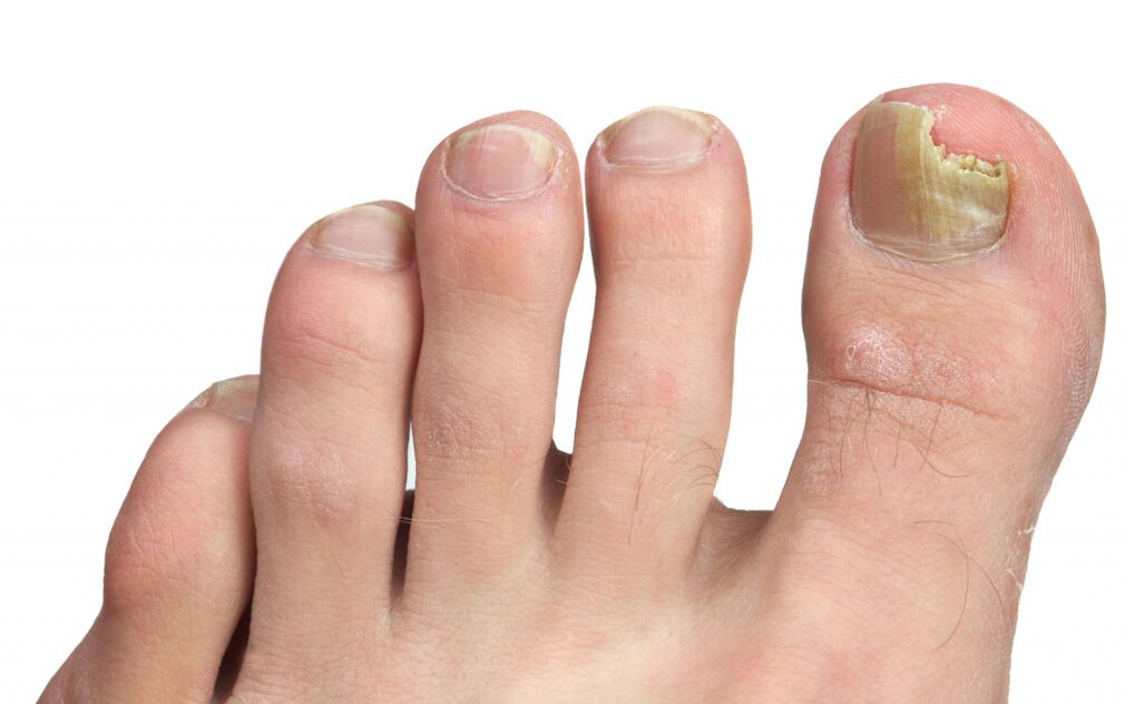 stades de la mycose des ongles des pieds