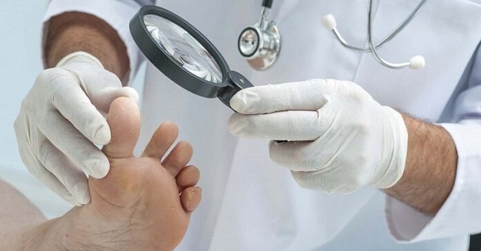 le médecin examine les pieds pour la mycose des ongles