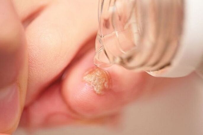 traitement des champignons des ongles avec du vinaigre