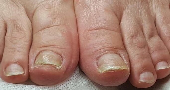 dommages aux ongles avec des champignons sur les pieds